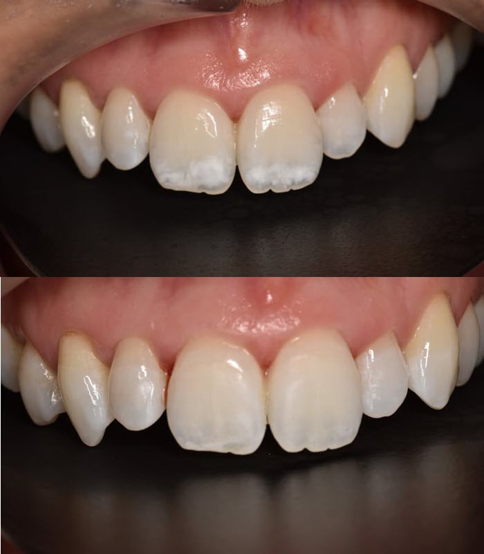 Sarah - whitespot treatment (upper)