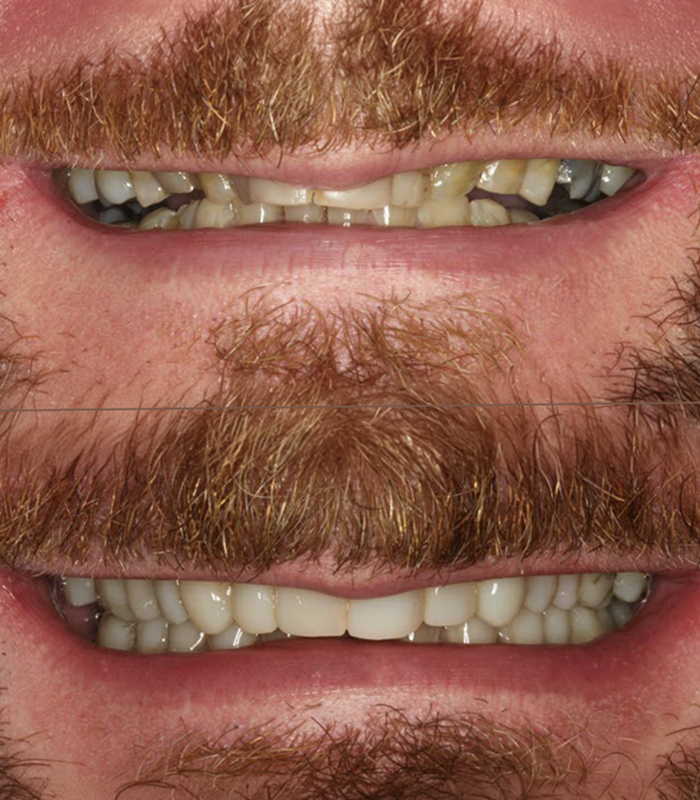 Gary : Invisalign and composite bonding