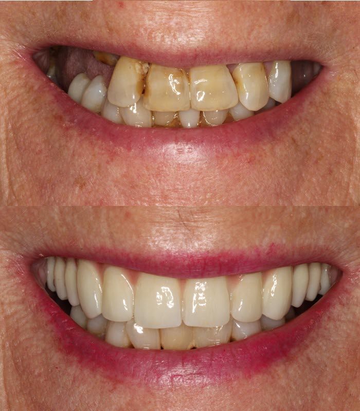 Erin : Dental Implant Treatment with Porcelain Bridge